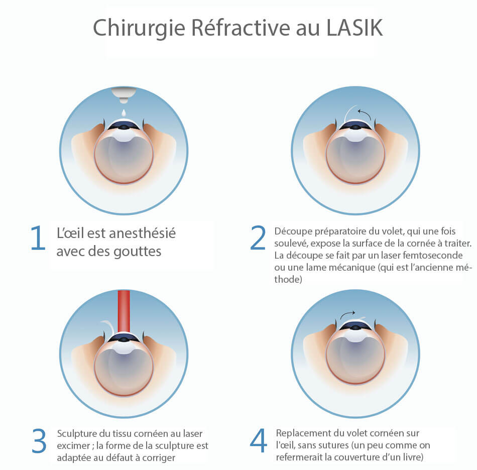chirurgie-des-yeux-refractive-lasik